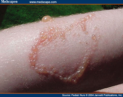 small poison oak rash. mild poison oak rash pictures.